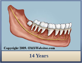 Wisdom Teeth Extraction 14 years