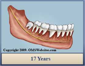 Wisdom Teeth Extraction 17 years